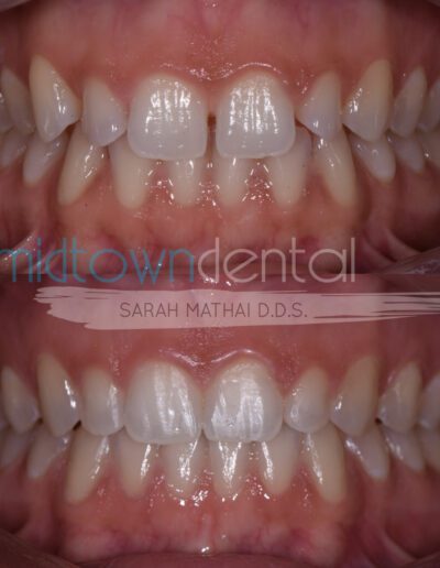 Invisalign treatment before and after photo of a Midtown Dental patient