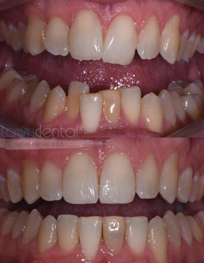 Before and after Midtown Dental Invisalign patient teeth close up