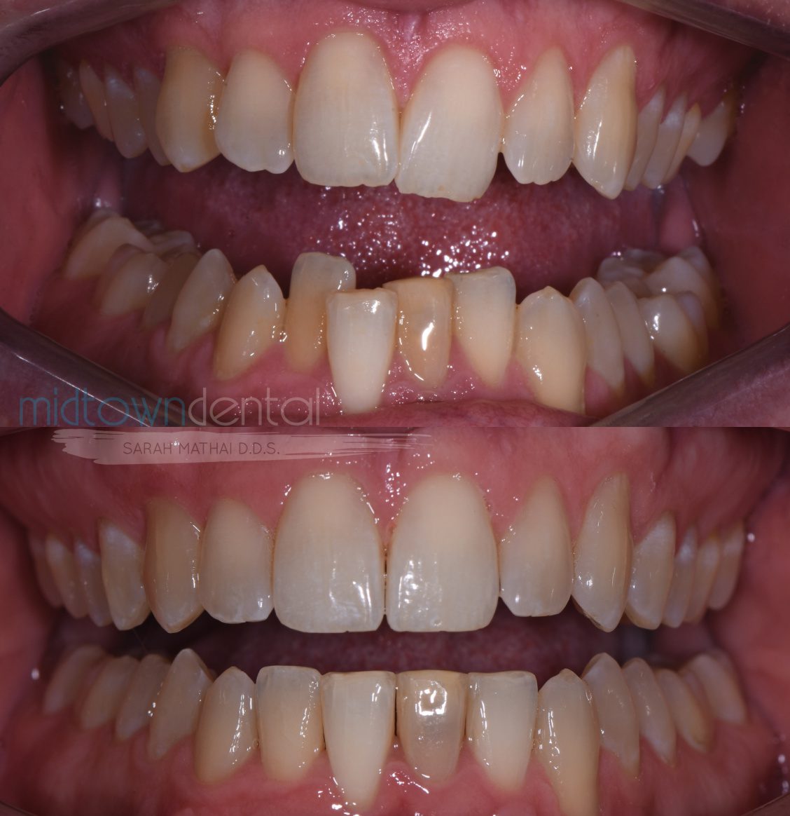 Invisalign Before & After