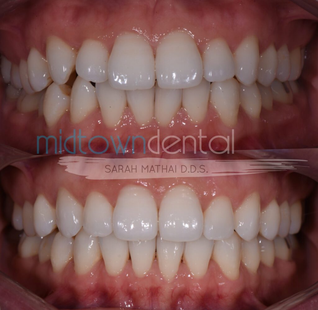 invisalign before and after closeup