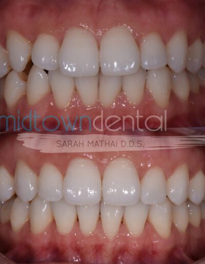 invisalign before and after closeup