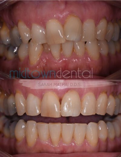 Invisalign treatment before and after photo of a Midtown Dental patient