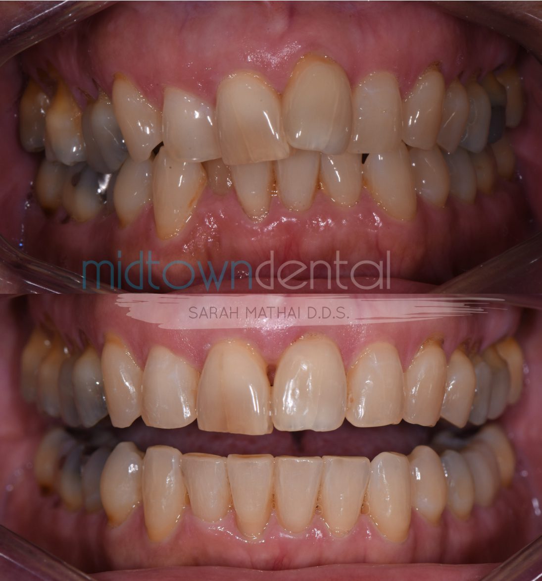 Invisalign Before & After