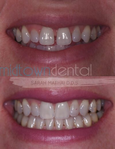 Invisalign treatment before and after photo of a Midtown Dental patient