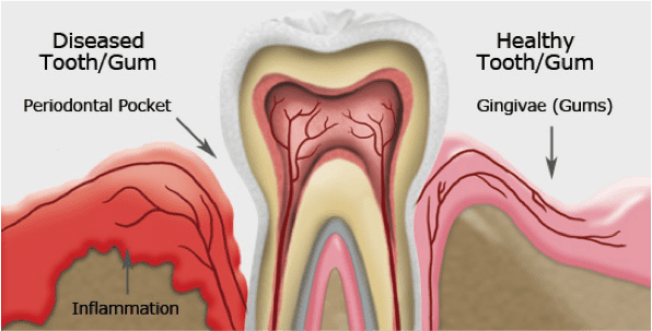 Gum Disease