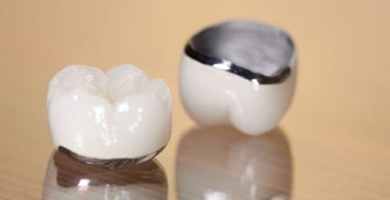 Porcelain Fused to Metal Crowns