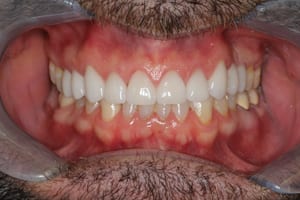 Healthy Teeth After Cosmetic Dentistry