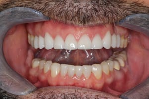 Healthy Teeth After Cosmetic Dentistry - Open Mouth