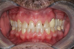 Unhealthy Teeth Before Cosmetic Dentistry