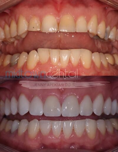retracted view of before and after cerec veneer case