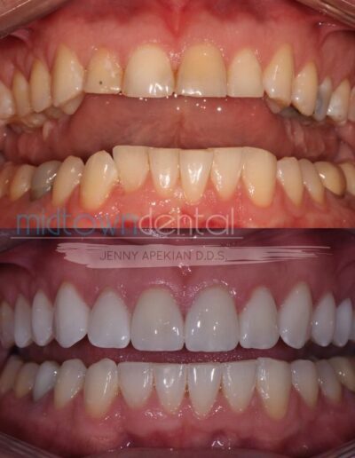 retracted view of before and after cerec veneer case