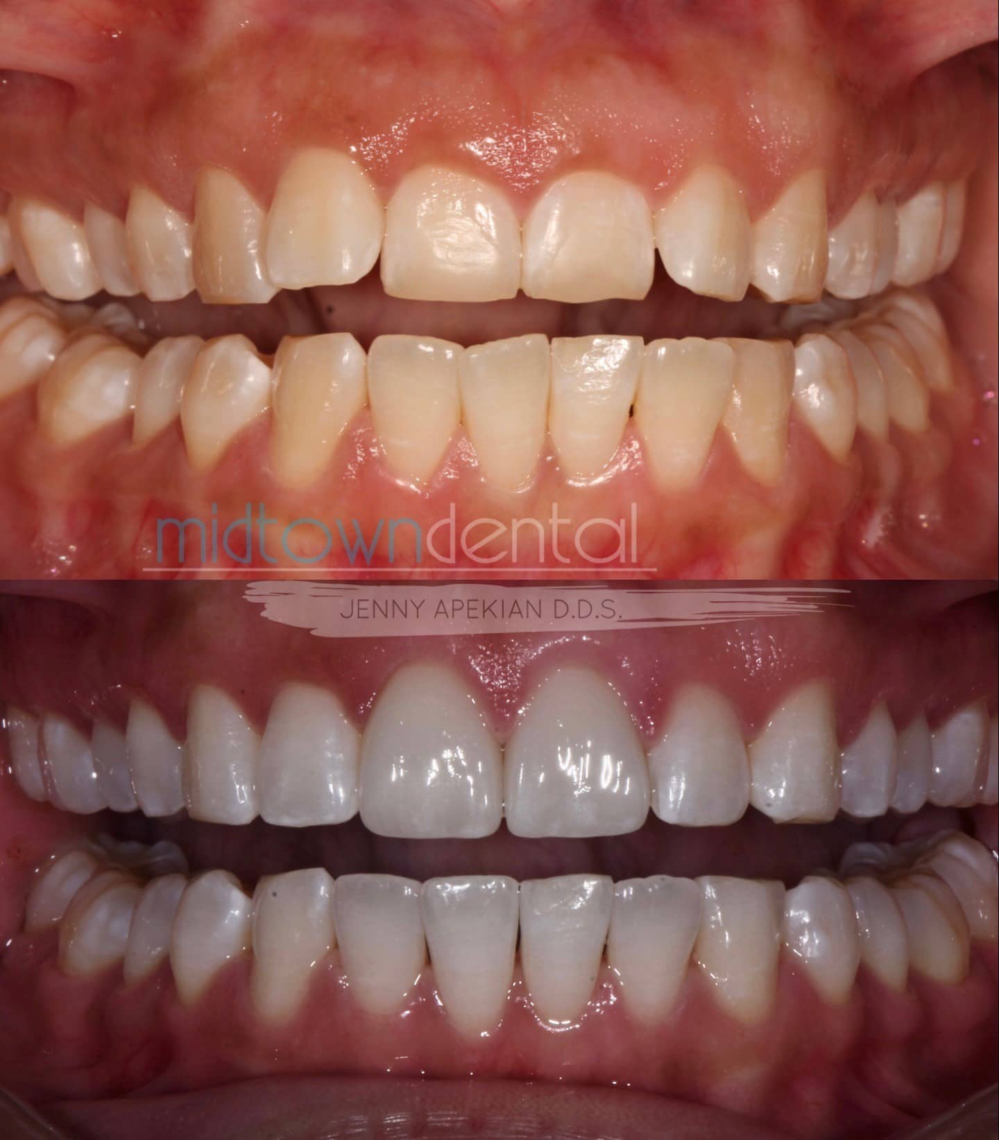 Cerec Veneers with Gum Lift Before & After