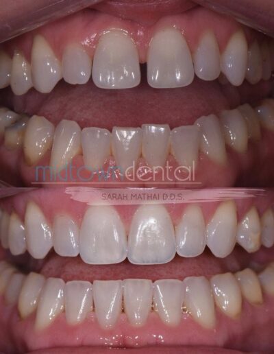 retracted view of invisalign treatment before and after