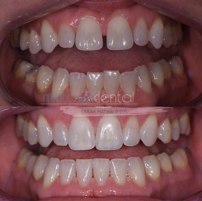 Invisalign Before & After