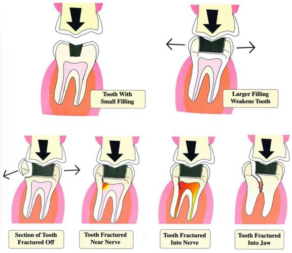 Tooth Fracture Diagram Tooth Fracture Diagram