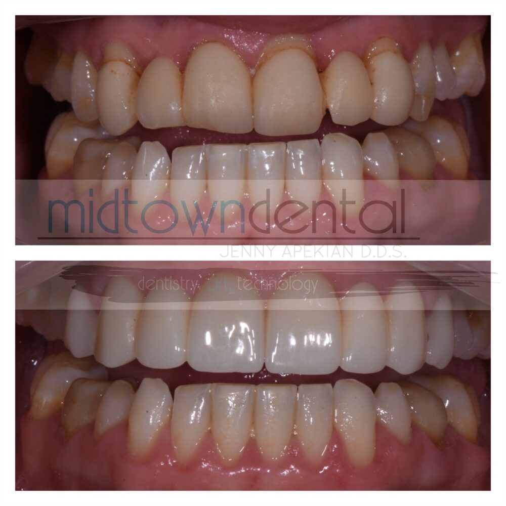 Upper Dental Bridges Before & After
