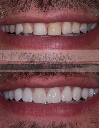 veneers after invisalign and teeth whitening smile before and after