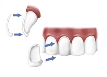 Porcelain Veneers being applied to a tooth