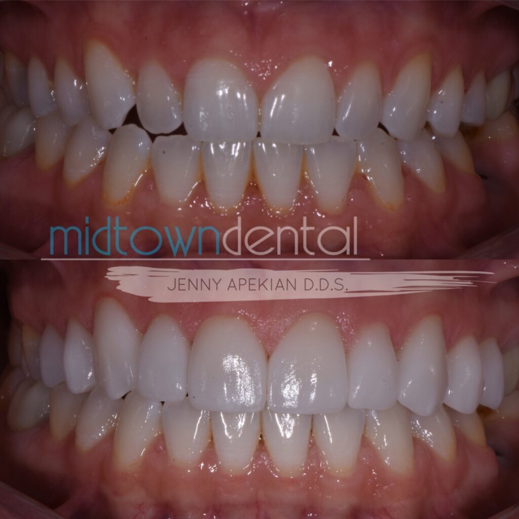 Cerec Veneers and whitening before and after photo