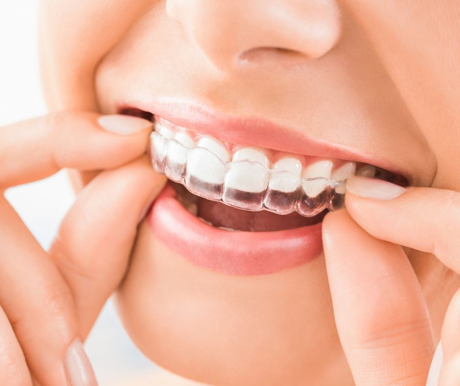 How Much Does Invisalign Cost Midtown Dental Sacramento, CA